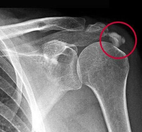 Os raios X mostraron depósitos de sales de calcio na articulación