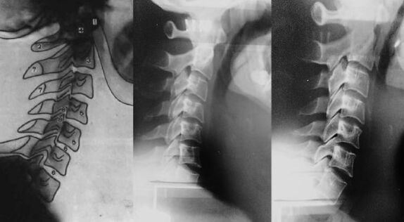Pescozo cun desprazamento da primeira vértebra cervical