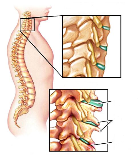 Como é a osteocondrose