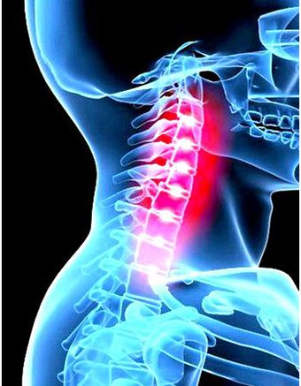 Imaxe clínica da osteocondrose